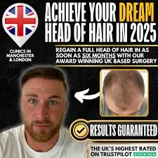 Review of Now Hair UK: Innovations in Hair Restoration